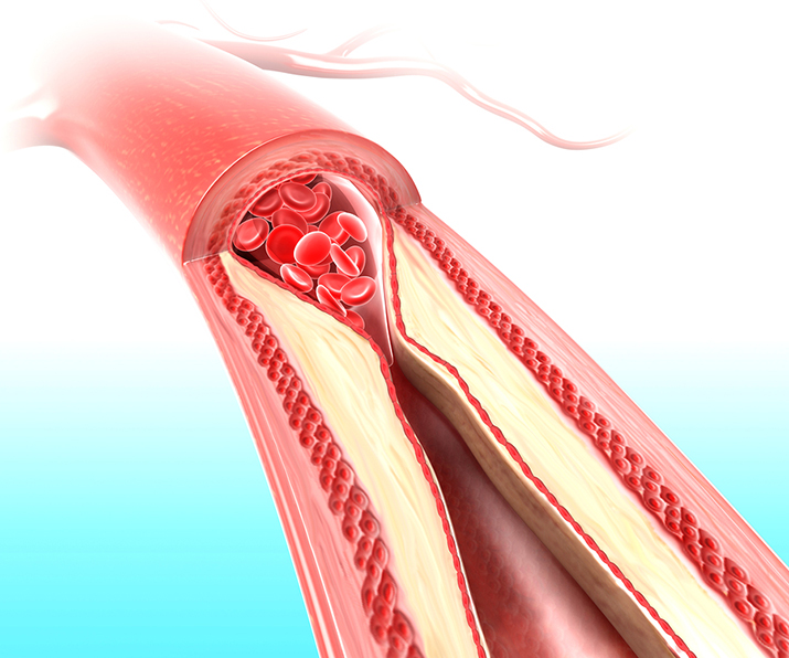 Cholesterol zatykający przepływ krwi