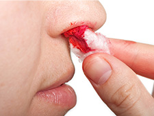 Krwawienie z nosa u dziecka